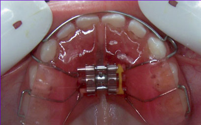 Le bilan première étape du traitement orthodontique.