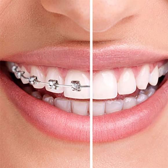 QU'EST CE QUE L'ORTHODONTIE